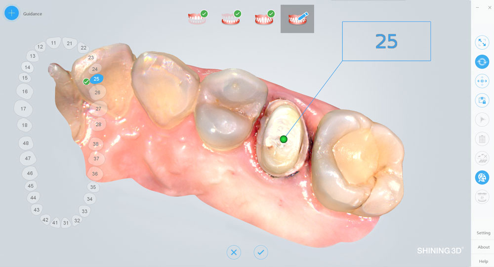 口腔内スキャナー「A-Oralscan2」のメリットとは？特徴や開発背景まで解説